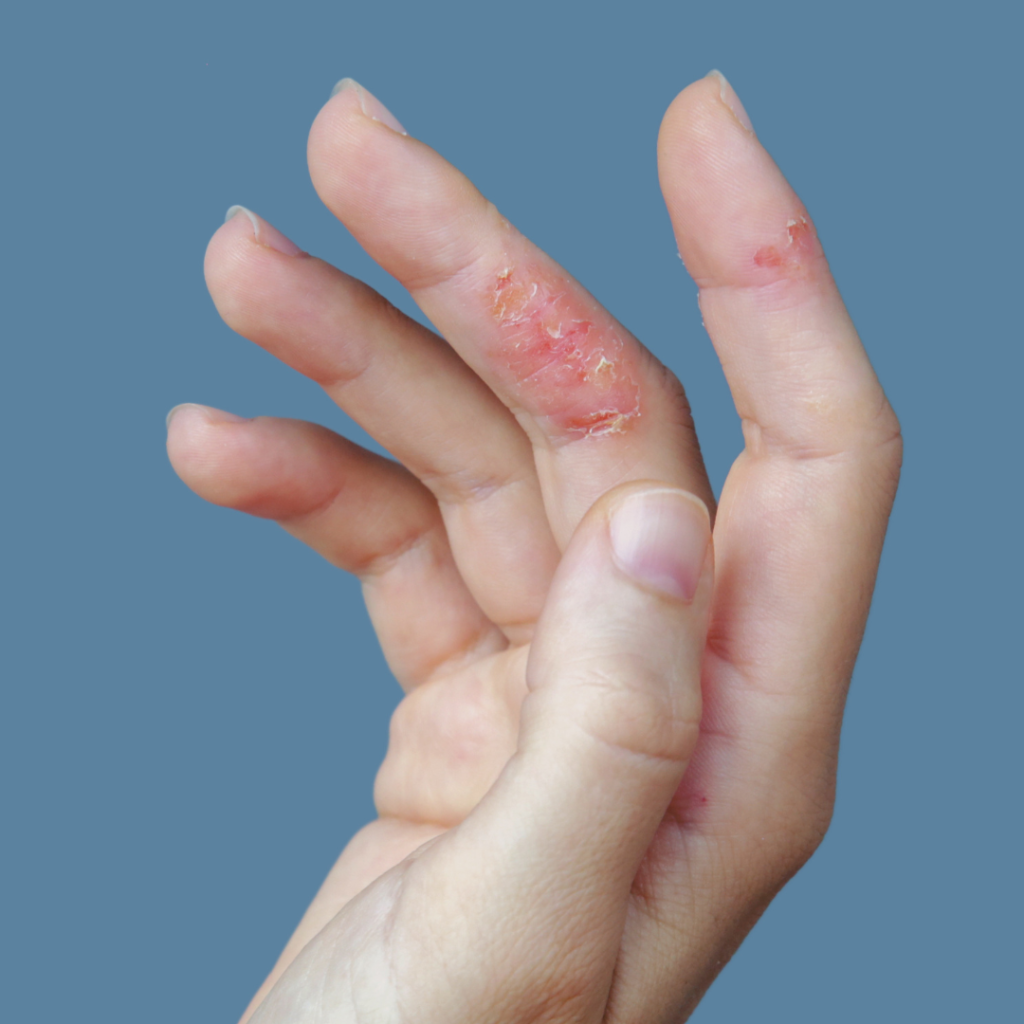 Bàn tay bị chàm cơ địa khô, nứt, đỏ.