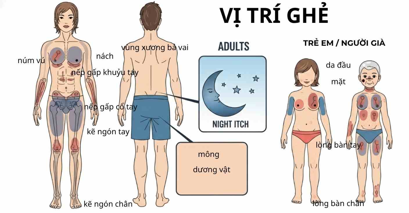Bản đồ vị trí tổn thương bệnh ghẻ ở người lớn và trẻ nhỏ