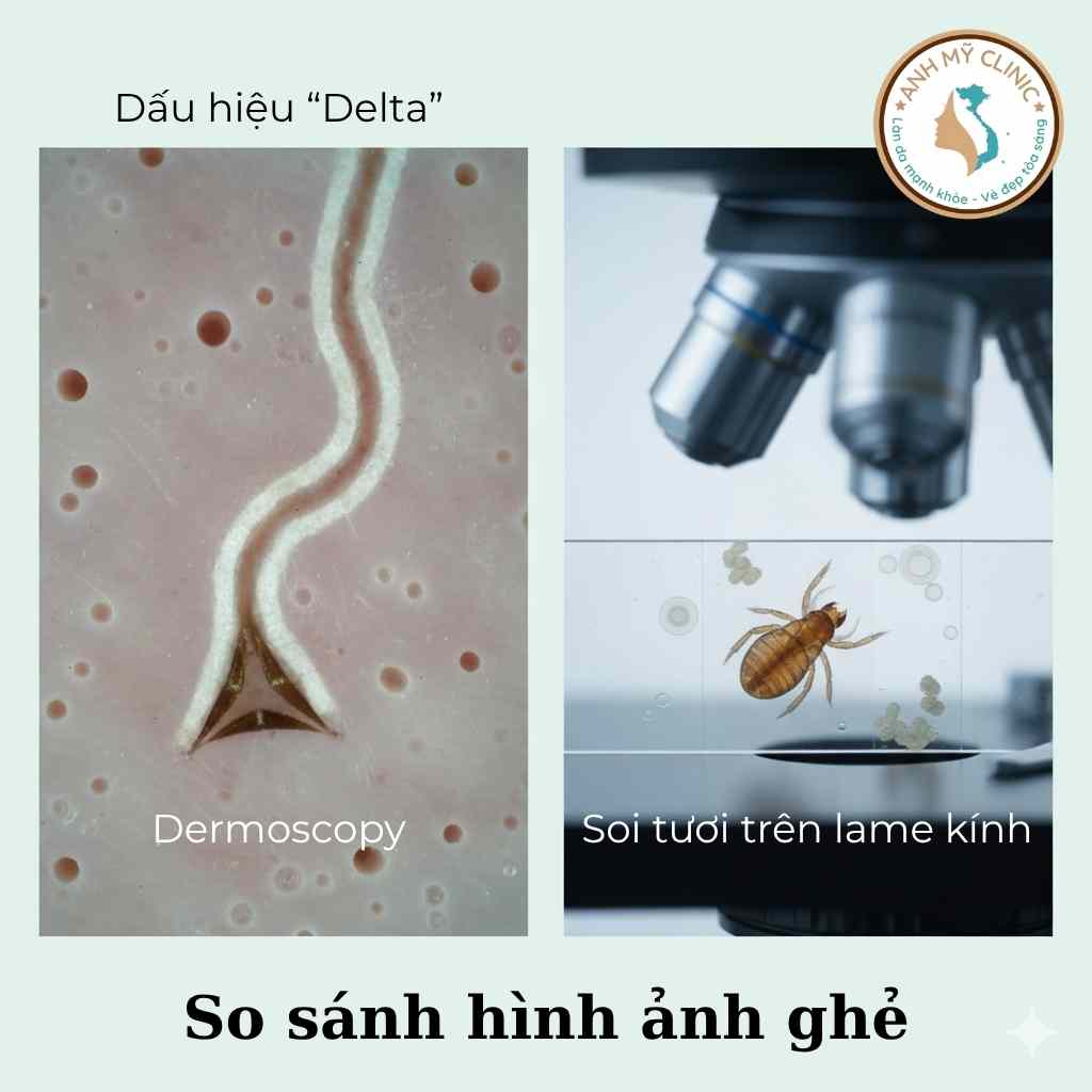 Soi da thấy dấu delta, cạo da soi kính xác nhận bệnh ghẻ