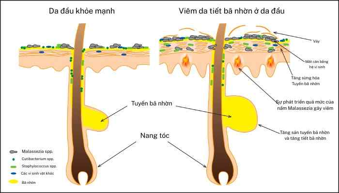 Sơ đồ cắt ngang da đầu so sánh giữa da đầu khỏe mạnh và da đầu bị viêm da tiết bã nhờn, thể hiện tuyến bã phì đại, tăng tiết bã, dày sừng và sự phát triển quá mức của nấm Malassezia.