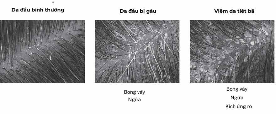 Ba hình ảnh vi mô so sánh da đầu bình thường, da đầu bị gàu và da đầu viêm da tiết bã, thể hiện mức độ bong vảy, ngứa và kích ứng khác nhau.