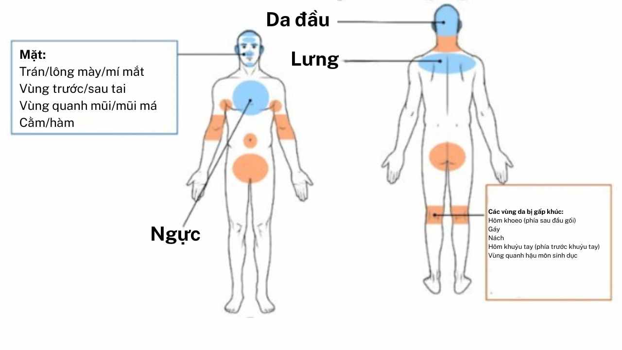 Sơ đồ cơ thể người nhìn từ trước và sau, tô màu vùng thường bị viêm da tiết bã gồm da đầu, mặt, ngực, lưng và các vùng da gấp khúc như gáy, nách, khuỷu tay, khoeo chân, quanh hậu môn – sinh dục.