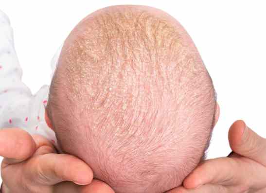 Hình ảnh viêm da tiết bã ở trẻ sơ sinh với vảy vàng nhẹ trên da đầu (cứt trâu).
