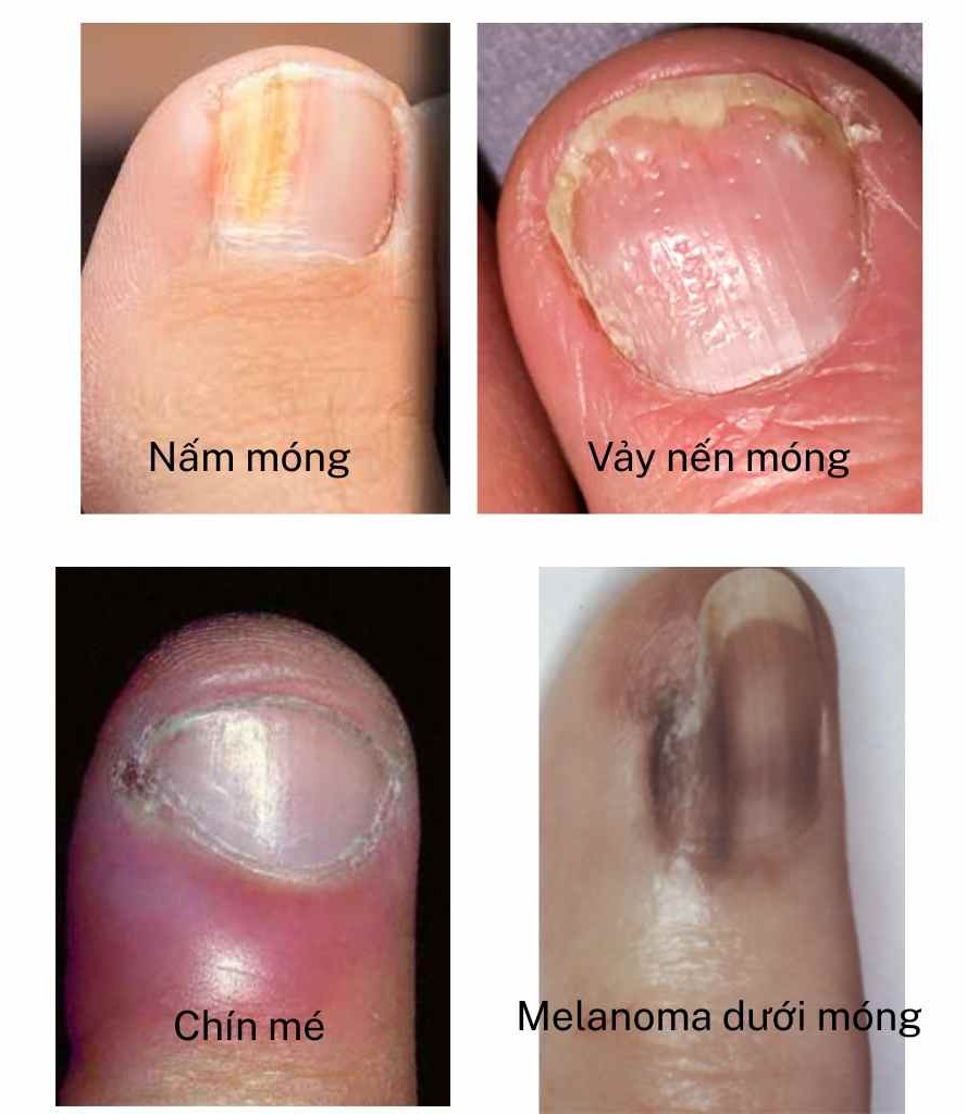 dau-hieu-benh-mong-bs-truong-le-dao_auszpb.jpg Hình ảnh tổng hợp các dấu hiệu bệnh móng: nấm móng, vảy nến móng, viêm quanh móng, u hắc tố dưới móng
