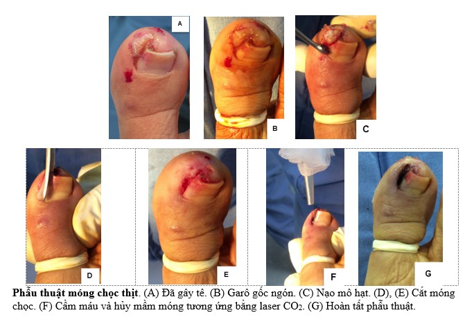 mong-choc-thit-ingrown-toenail-bs-truong-le-dao_yfu39a.jpg  phẫu thuật điều trị móng chọc thịt bằng kỹ thuật partial avulsion – Phòng Khám Da Liễu Anh Mỹ.