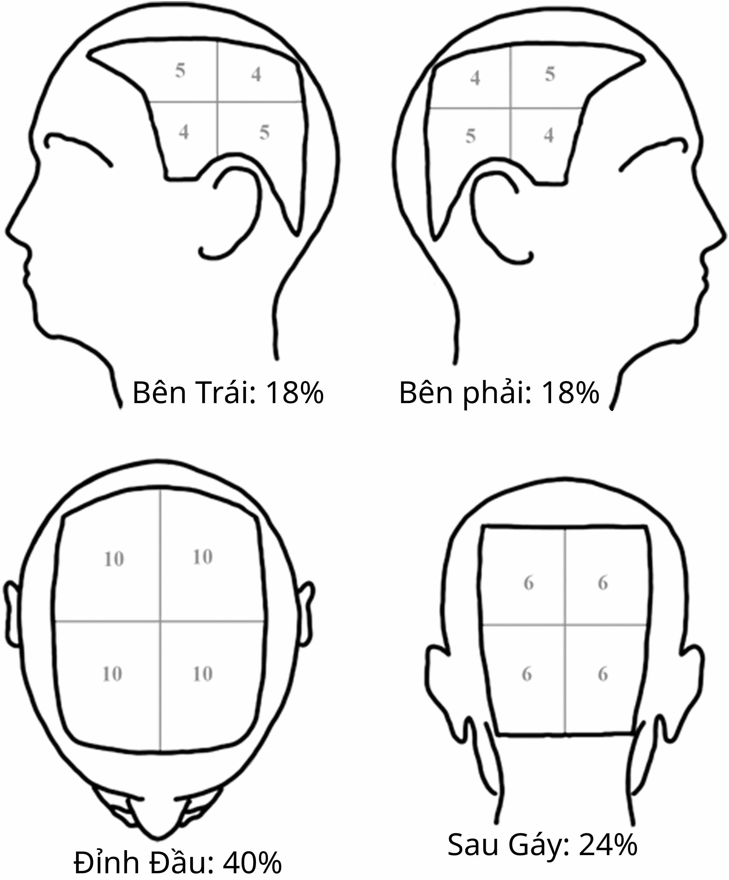 thang-salt-alopecia-areata_fytzsq.jpg Sơ đồ minh họa cách tính thang SALT đánh giá mức độ rụng tóc mảng.