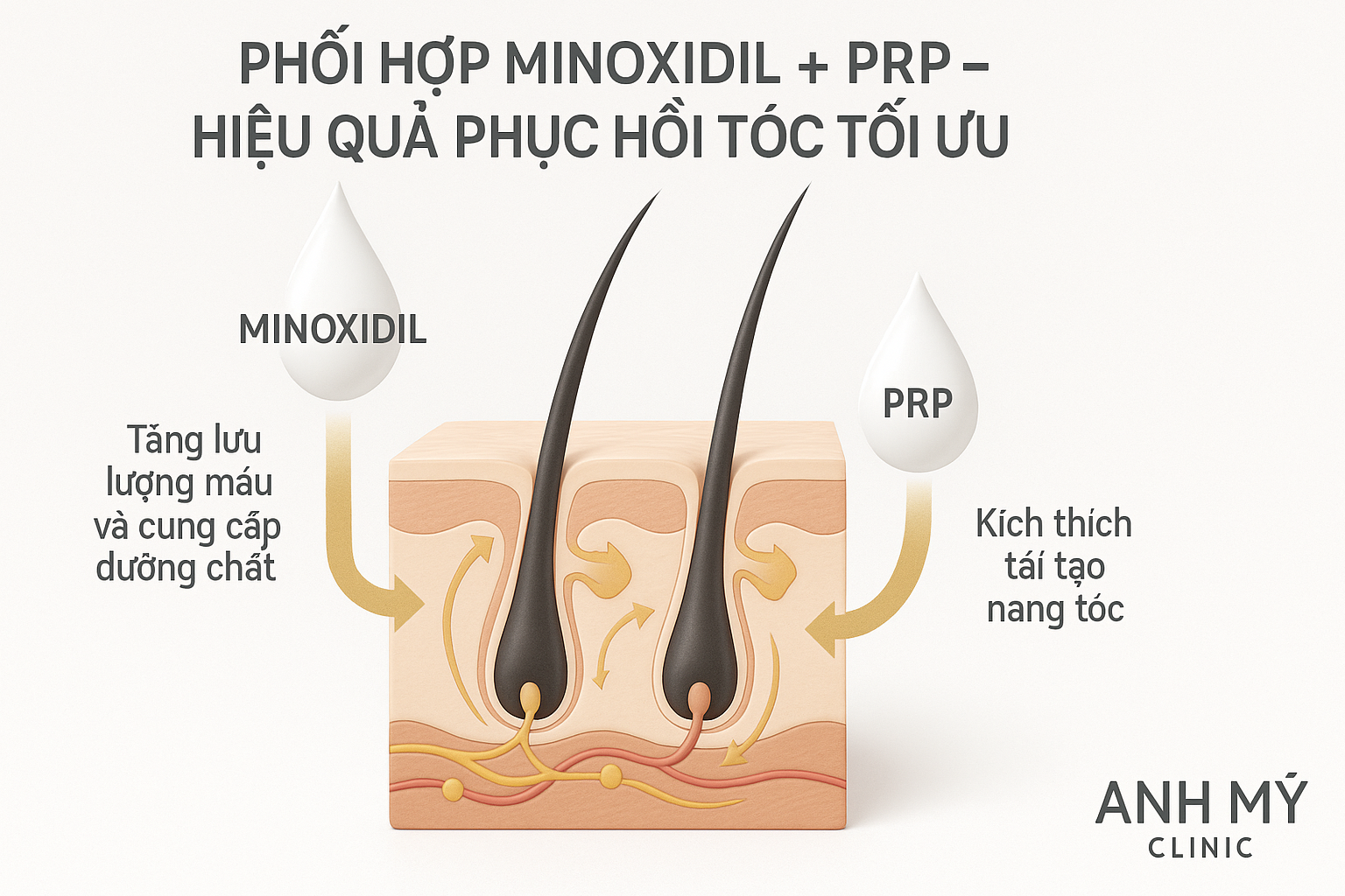 ket-hop-minoxidil-prp-anh-my-clinic_fxwqjx.png Sơ đồ mô tả cơ chế bổ trợ giữa Minoxidil và PRP giúp tăng mật độ tóc nhanh chóng tại Anh Mỹ Clinic