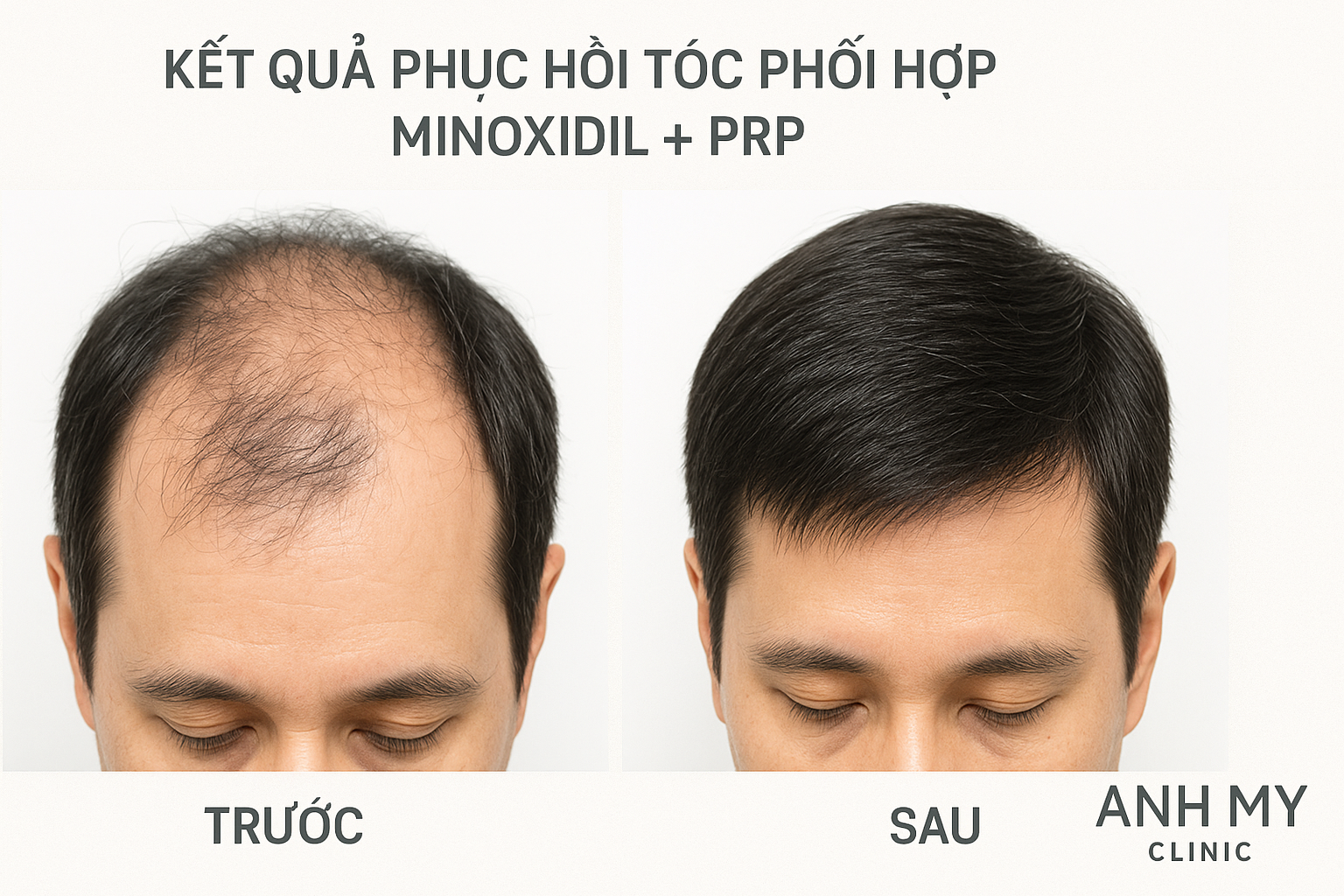 hieu-qua-hiep-dong-minoxidil-prp-anh-my-clinic_qb5ctj.png  Ảnh trước và sau điều trị kết hợp Minoxidil và PRP cho bệnh nhân rụng tóc tại Phòng Khám Da Liễu Anh Mỹ