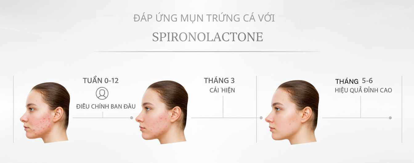 Infographic mô tả timeline hiệu quả spironolactone trong mụn tuổi dậy thì nữ: 8–12 tuần bắt đầu đáp ứng, 5–6 tháng tối đa.