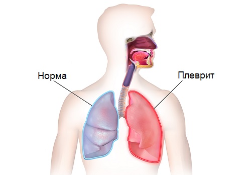 При кашле болит левая