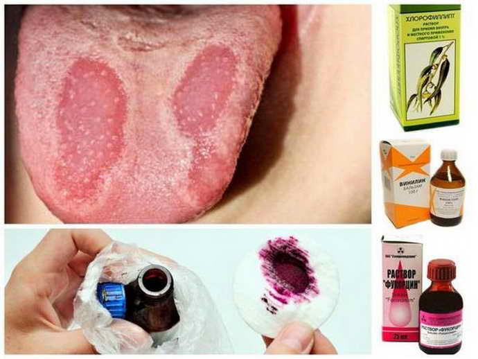 Виды стоматита у детей лечение