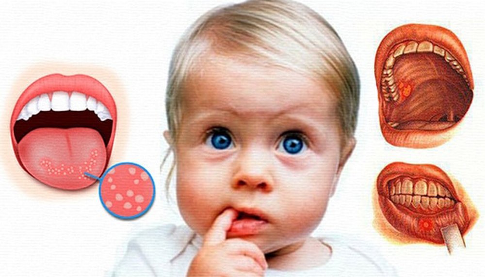 Виды стоматита у детей лечение