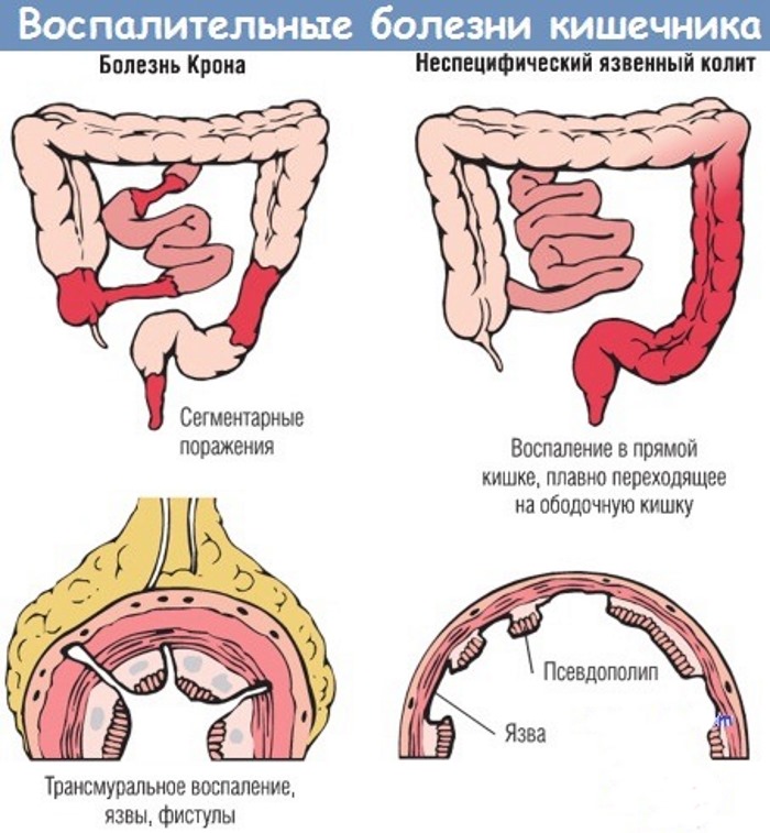 Боль при воспалении кишечника у взрослого