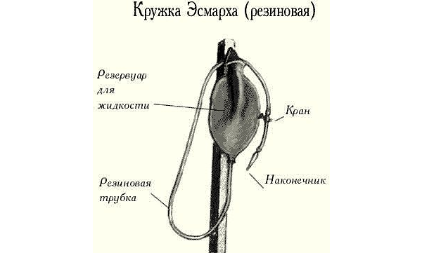 Чем заменить кружку эсмарха в домашних условиях Подготовка к процедуре фкс