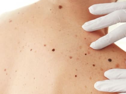 Битва с мифами: онколог развенчивает заблуждения о родинках