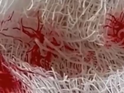 15-сантиметрового паразита обнаружили в груди россиянина после укуса комара