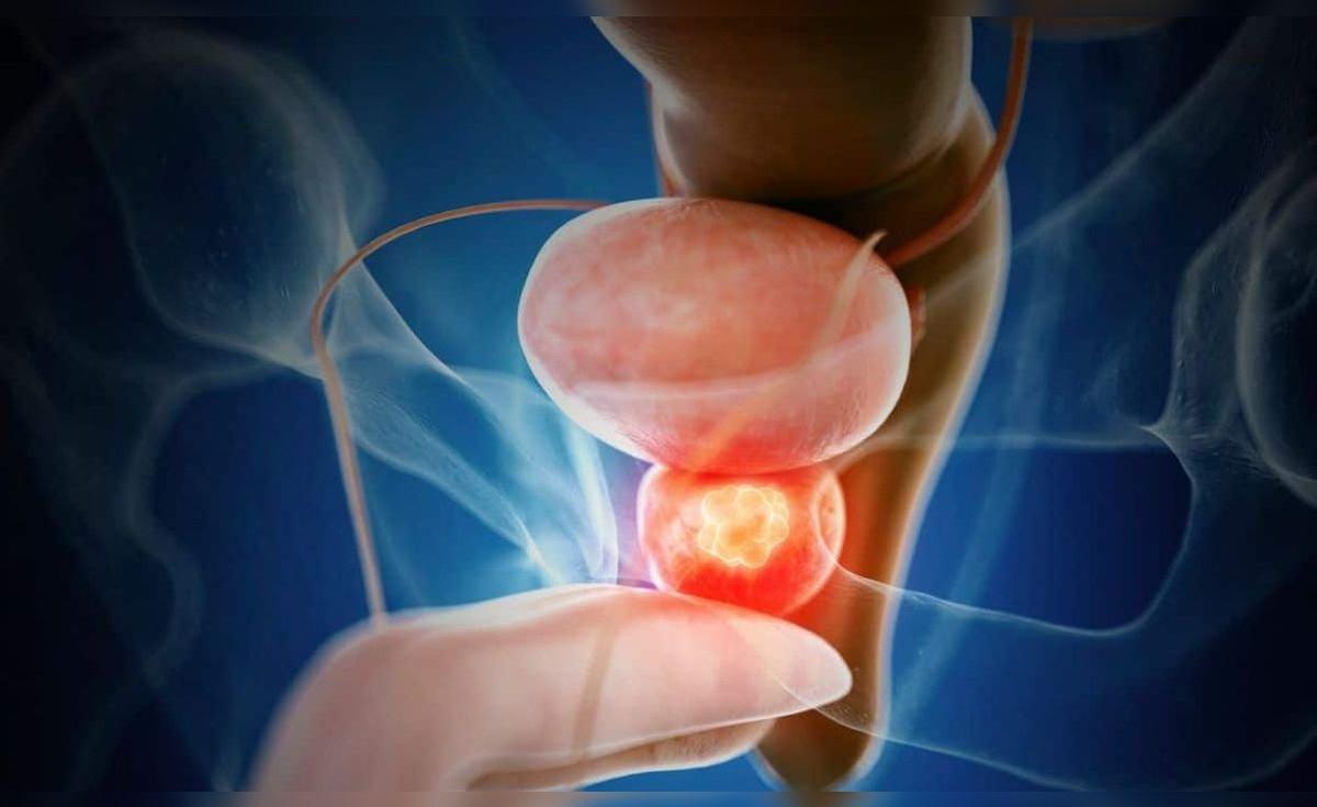 Avances en tratamiento del cáncer de próstata agresivo destacan en estudio internacional