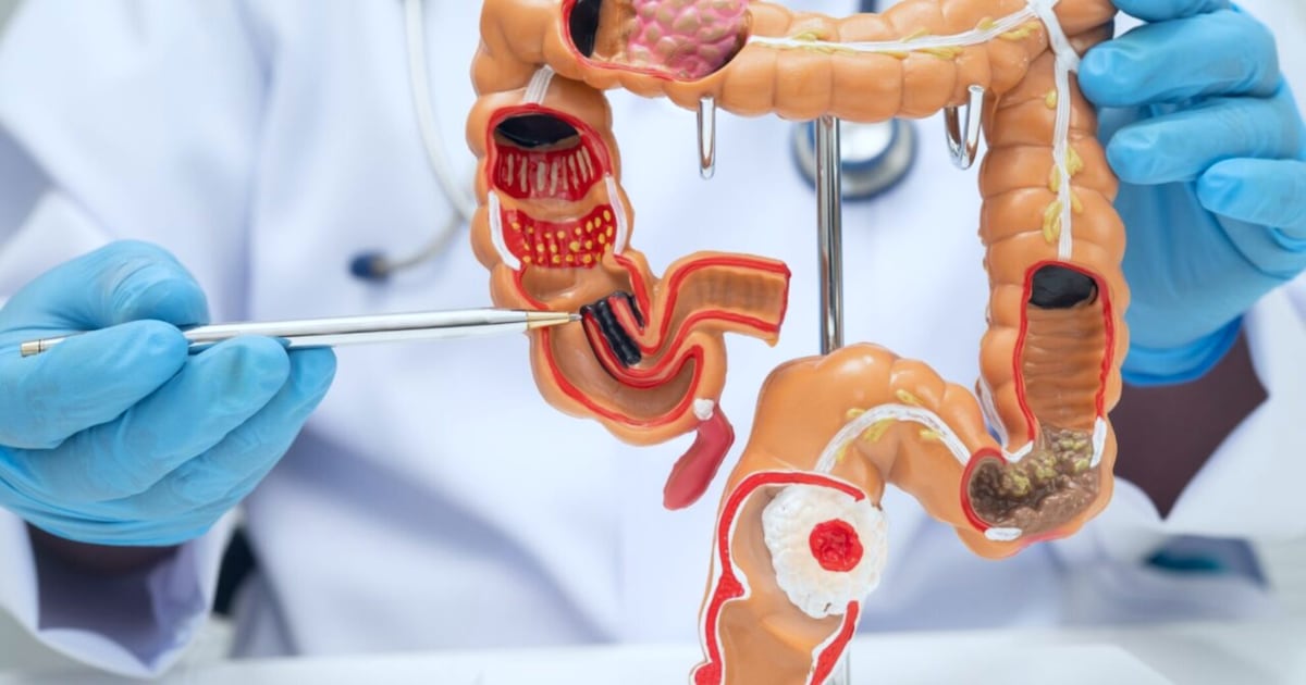 Nueva investigación revela mecanismo de propagación del cáncer de colon