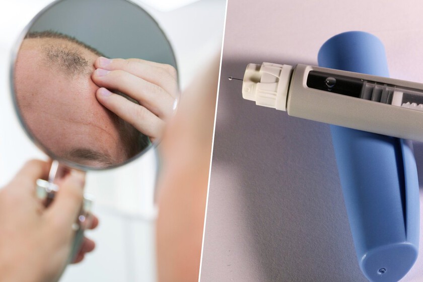 Estudio vincula uso de medicamentos GLP-1 con riesgo de pérdida de cabello en pacientes diabéticos