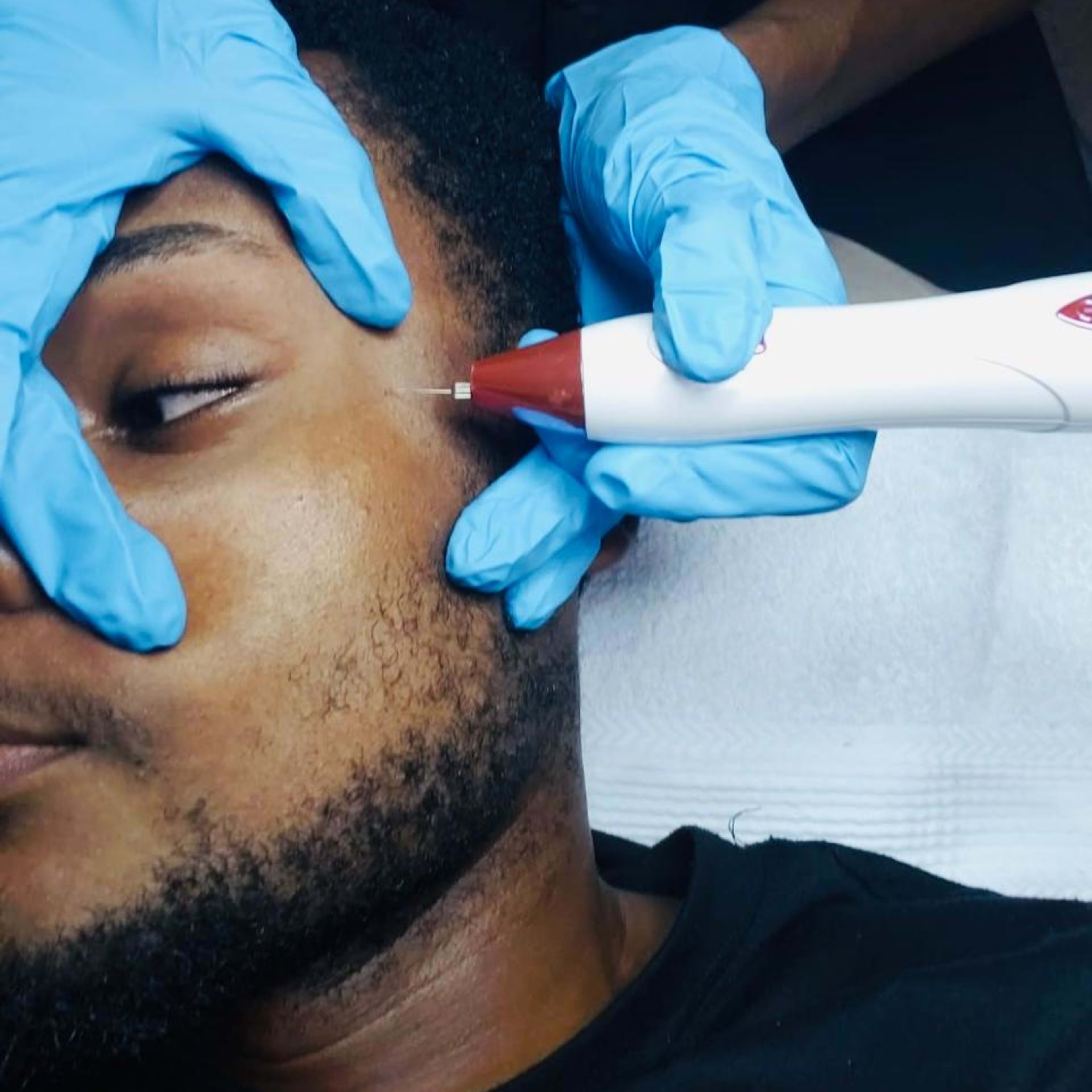 wart-removal.jpeg