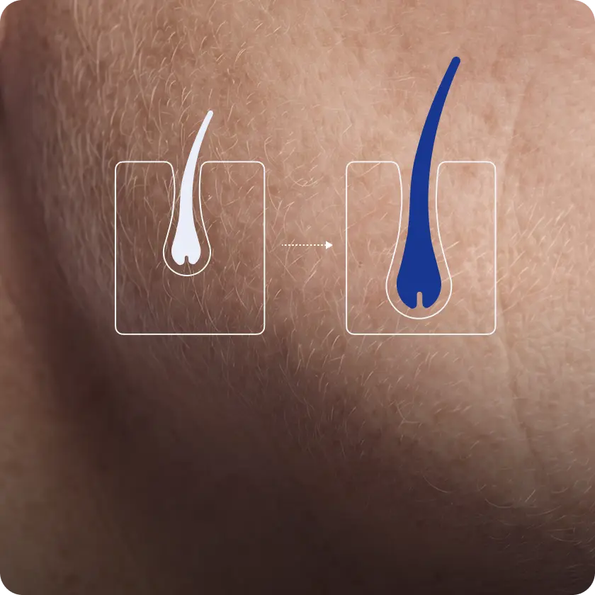 Illustration: a hair follicle responding to hormonal change