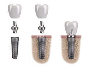 Three Reasons Why You Should Choose Dental Implants