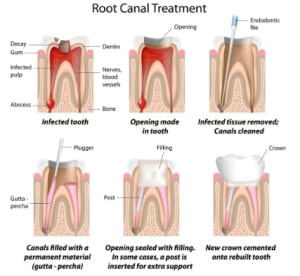 The Dreaded Root Canal, Why me and What Now?