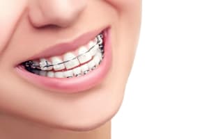 What are Dental Braces?