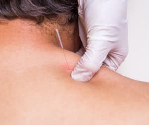 Cupping & Dry Needling: Relief + Reset for Long-Term Movement Health