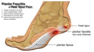 heel pad injury