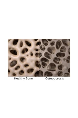 Osteoporosis: Remedies to manage Osteoporosis