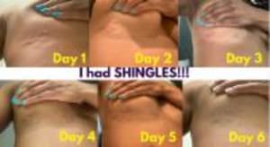 I had SHINGLES!!!