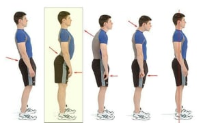 Do We Need Mobility or Stability to Fix an Excessive Back Arch AKA Lordosis?