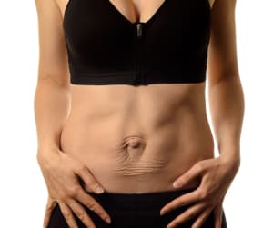 What is abdominal separation, and can it be fixed?