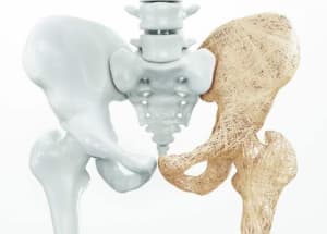 Osteoporosis Exercises & Tips To Improve Bone Density