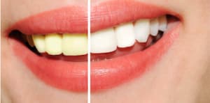 Teeth Whitening Tips: What you didn't know