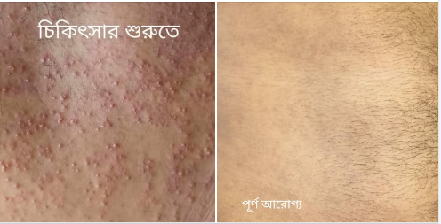 স্ক্যাবিস থেকে আরোগ্য