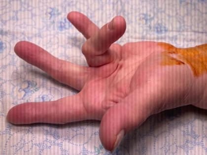 Во Владимире проводят уникальные операции по восстановлению функции кисти рук