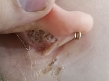 Хирурги ЧОДКБ спасли девочке ухо, которое повредила редкая болезнь