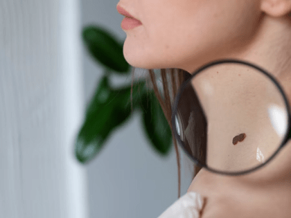 Нет ли риска онкологии: жителей Челябинска приглашают проверить родинки