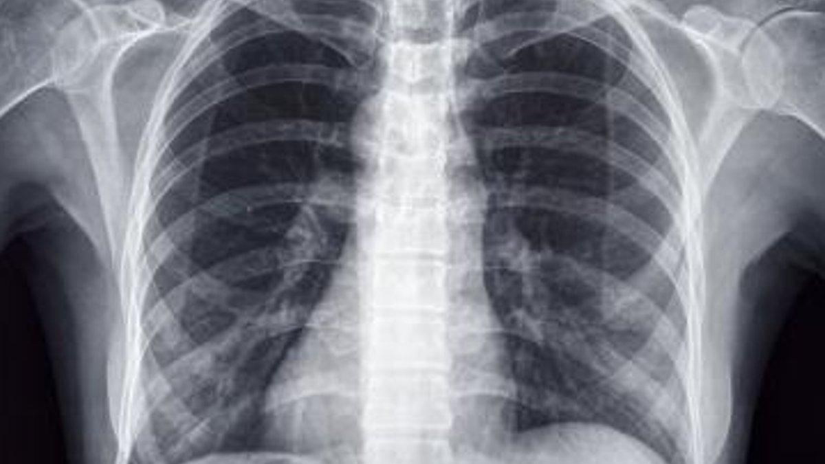 X-ray scan detects post-surgery heart issue in seven seconds X-ray scan detects post-surgery heart issue in seven seconds - x-ray scan