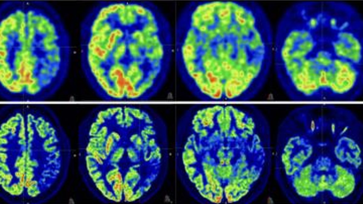 High-Resolution PET Scanner Detects Early Brain Disease Signs High-Resolution PET Scanner Detects Early Brain Disease Signs - pet scanner early detection