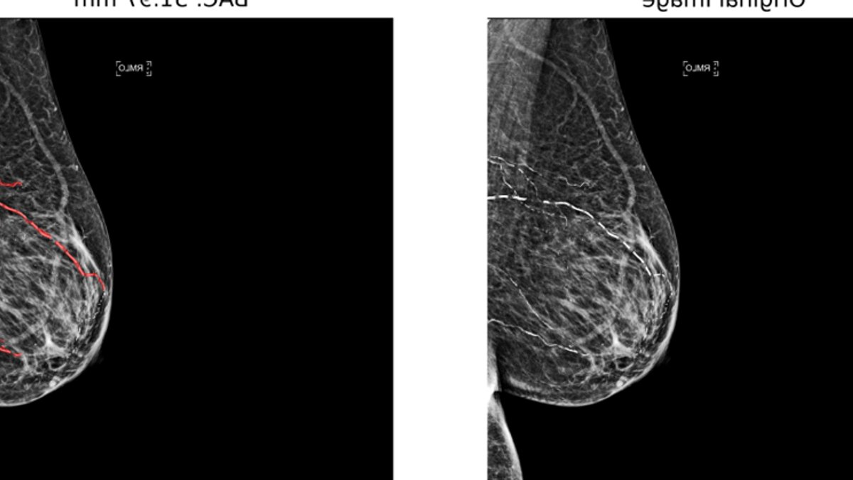 Mammograms May Help Identify Heart Disease Risk Mammograms May Help Identify Heart Disease Risk - mammograms heart disease