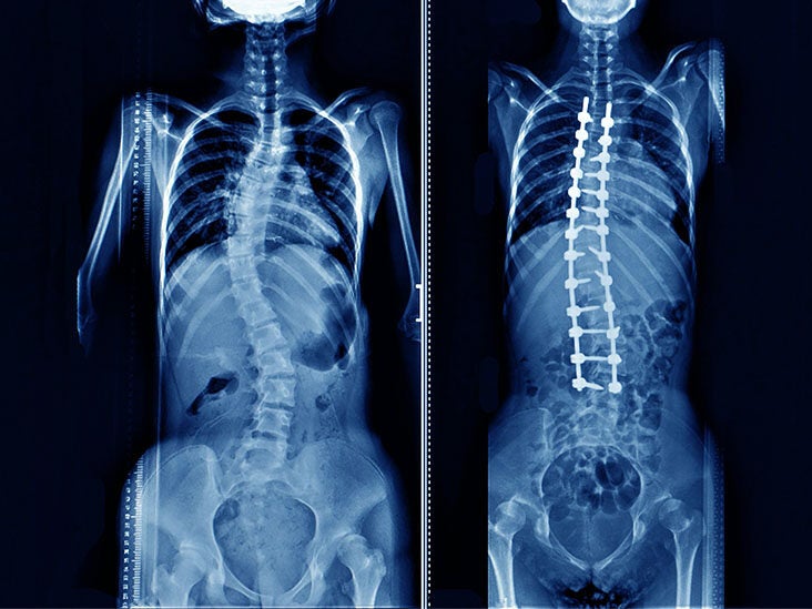 Minimally Invasive Spinal Surgery and its Advantages
