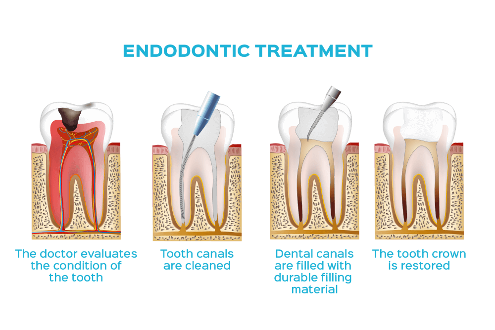 Common Treatments Offered by Endodontists
