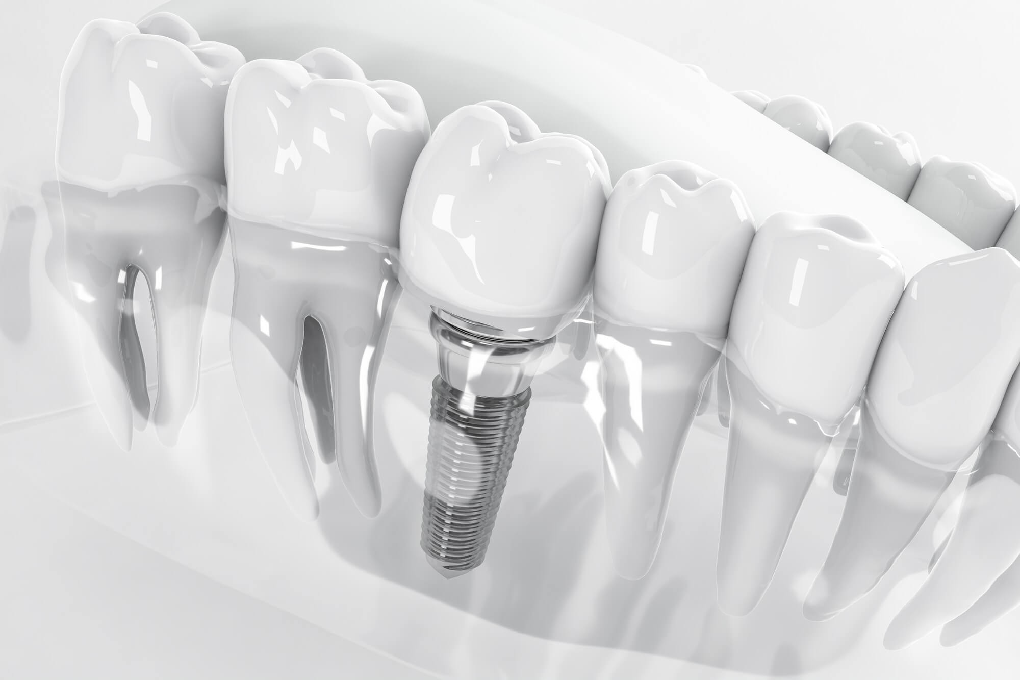 The Role of Metal, Screw-like Posts in Replacing Your Tooth Roots