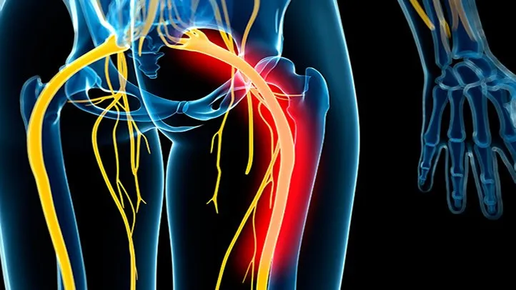 An In-Depth Guide About Sciatica