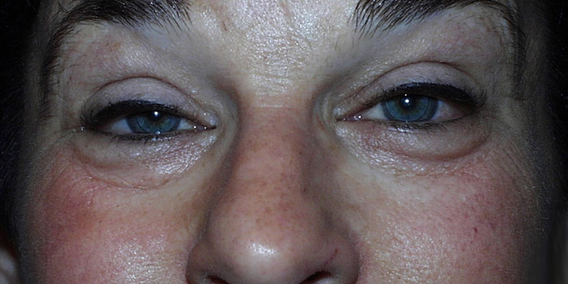 Factors That Put You at Greater Risk of Having Ptosis