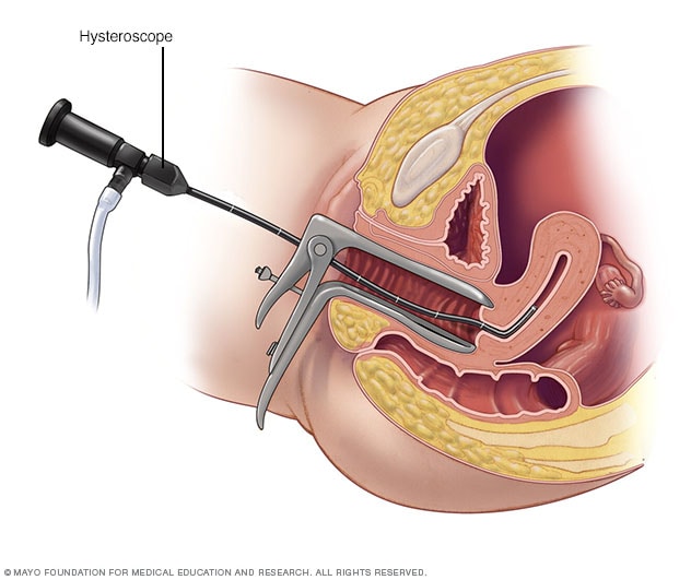 An Inside Look Into Hysteroscopy