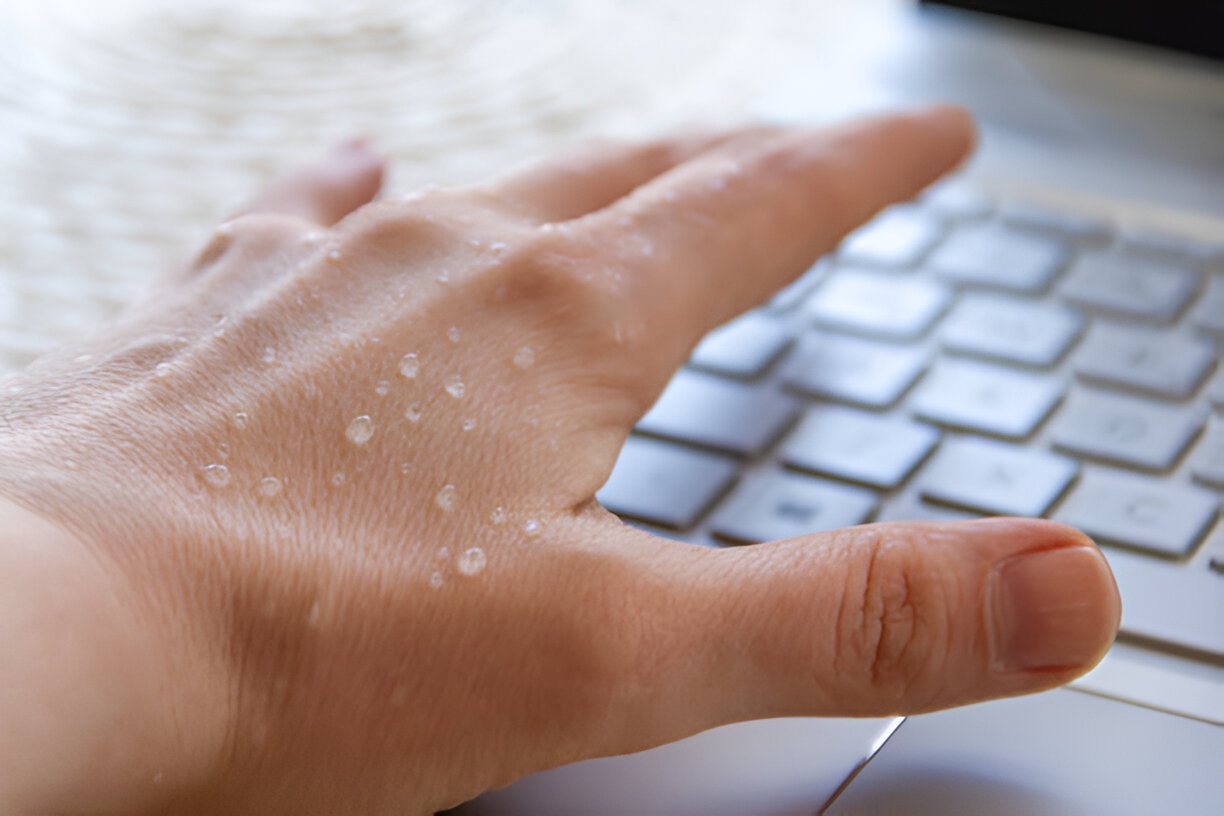 Are sweaty hands a sign of illness?
